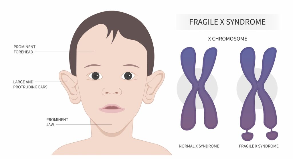 Illustration of a child with Fragile X syndrome, highlighting prominent physical features including a prominent forehead, large and protruding ears, and a prominent jaw, alongside a comparison of normal X chromosome and Fragile X syndrome chromosome.